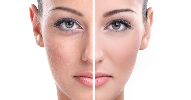 hyperpigmentation