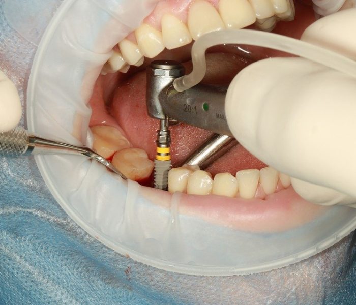 dental implant